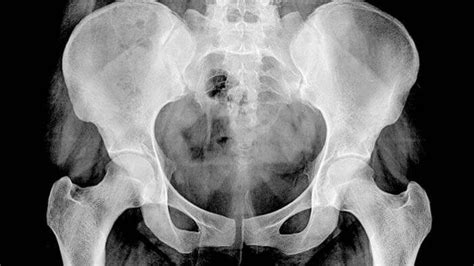 Femoral neck fracture, hip dislocation, scaphoid fractur. Avascular Necrosis - Tribunnewswiki.com