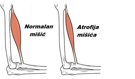 Atrofija mišića noge ili ruke - uzrok, simptomi i tretman