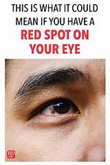 When blood gets trapped beneath this layer, it's called subconjunctival. This Is What It Could Mean if You Have a Red Spot on Your ...