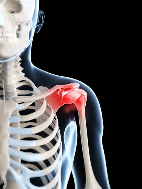 Timing Of Shoulder Injections Impacts Surgical Infection Risk Rheumnow