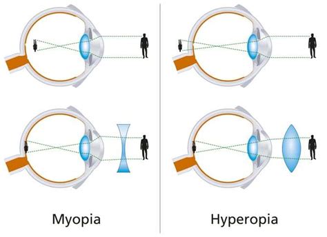 Myopia Vs Hyperopia Heffingtons House Of Vision