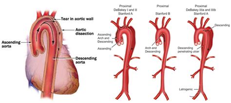 Aortic Dissection Varicose Veins Vascular Surgeon Stroke Dvt