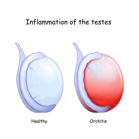 Epididymitis Orchitis Colin Teo Urology