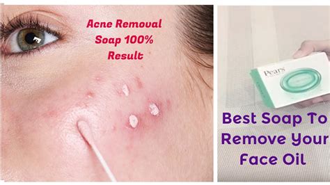 Best Soap For Oily And Acne Prone Skin Pears Soap Review Acne Removal