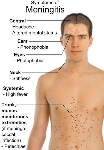 Meningococcal Meningitis Symptoms
