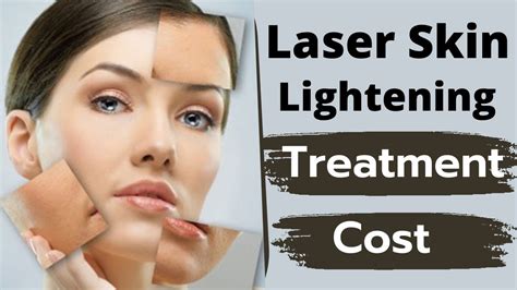 Laser Skin Lighteningwhitening Treatment And Cost लेज़र ट्रीटमेंट मे
