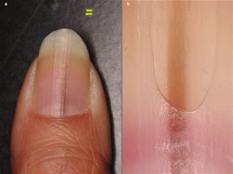 A Clinical Presentation Of The One Nail Brown Band Tapering From The