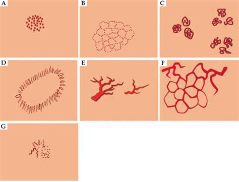 SciELO Brazil Vascular Structures In Dermoscopy Vascular Structures
