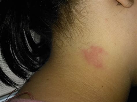 Red Rash Like Patch On Neck Not Itchy But Painful To Touch Swollen