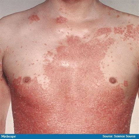Fast Five Quiz Psoriasis Types Page 5