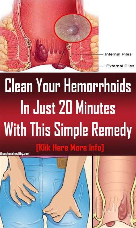Clean Your Hemorrhoids In Just Minutes With This Simple Remedy