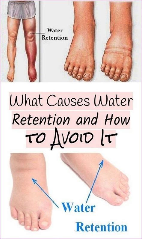 Causes Of Water Retention Water Retention Health Edema