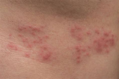 Shingles Rash Stock Photos, Pictures & Royalty-Free Images - iStock