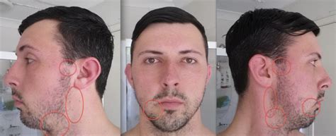 Beard minoxidil before and after. Amount of minoxidil for hair and beard together ...