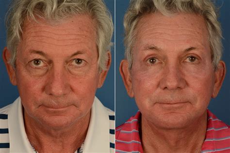 Blepharoplasty Blepharoplasty Male Photos Naples Fl Patient 19157