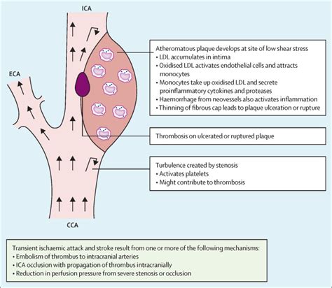 Management Of Atherosclerotic Extracranial Carotid Artery Stenosis