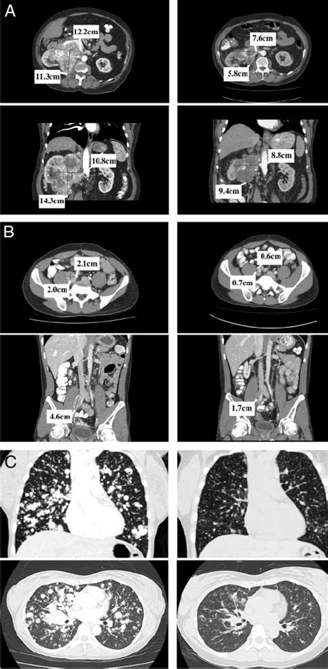 A Ct Scans Documenting Responses To Sunitinib In Patient 1 Pre