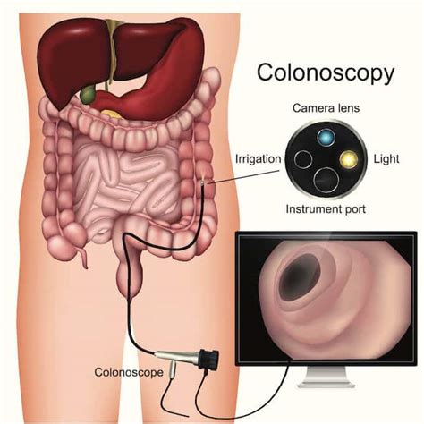 What To Expect When You Have A Colonoscopy The Ibs Dietitian