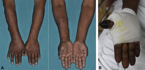 Pythiosis Presenting With Digital Gangrene And Subcutaneous Nodules