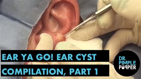Ear Ya Go 👂🏽ear Cyst Compilation Part I Mix It Up Compilations