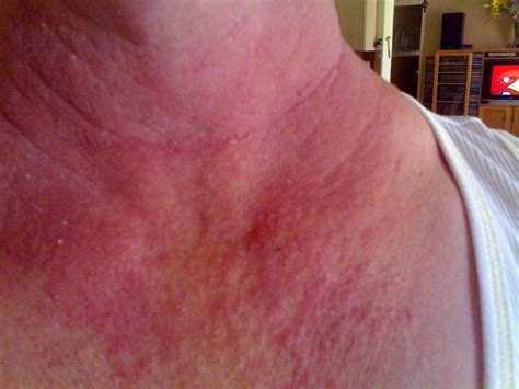 Why Do I Have A Red Itchy Rash On My Chest Design Talk