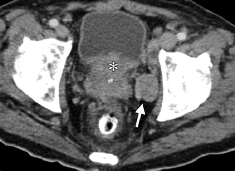 Axial Contrast Enhanced Ct Image Shows An Enlarged Left Obturator