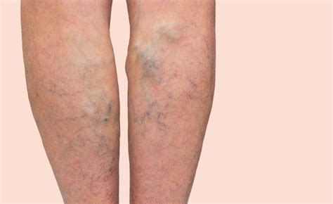 Why Varicose Veins Are More Than Just A Cosmetic Issue Imagination Waffle