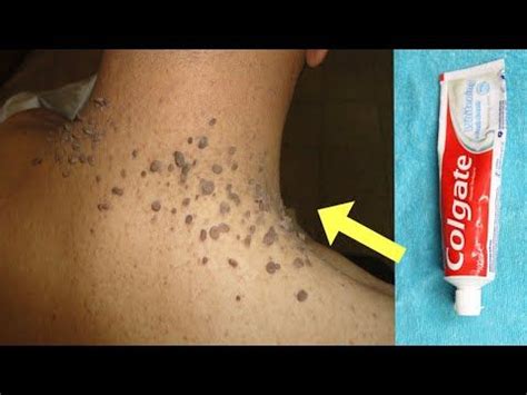 Here's how to get rid of mealybugs on cactus: IN JUST 1 WEEK - GET RID OF SKIN TAG WITH TOOTHPASTE ...