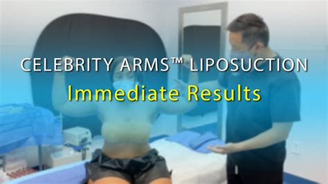Arm Liposuction Immediate Results Celebrity Arms Lipo Arms