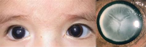 Cataracts often develop slowly and can affect one or both eyes. Bebeklerde Katarakt