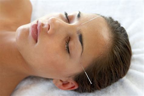 Using Acupuncture For Headache As A Treatment