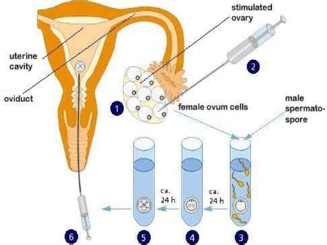 What Is Zift Procedure For Infertility Biology Blog