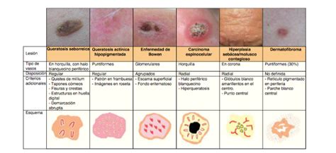 Ficha 13 Vascularización En Dermatoscopia 2 Dermatologia En