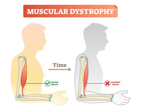 Duchenne Muscular Dystrophy Archives Health Issues India