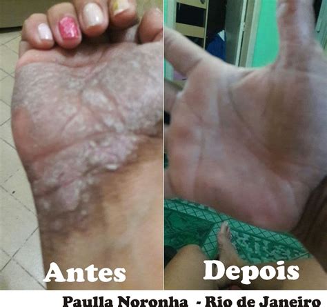 Nas persoas coa pel escura as manchas poden adquirir a cor púrpura. Dilênia Combo Com Creme 300ml Para Psoríase (fluido ...