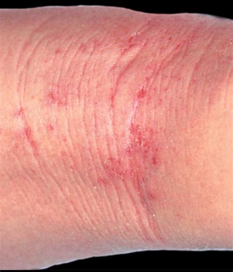 Dermatite At Pica Como Se Manifesta Quais As Op Es De Tratamento