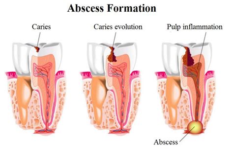 Which sinus infection can be affected. Tooth Abscess | Causes, Symptoms and Treatments ...