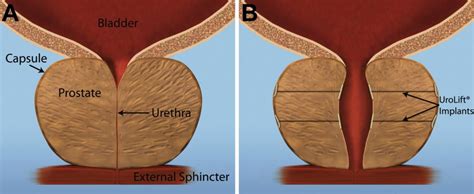 Urolift For BPH New Treatment Option For Men With Enlarged Prostate Specialists In Treatment