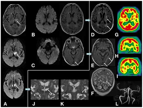 On Mri Examination Initial Diffusion Weighted And Flair Sequences