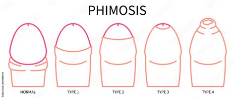 Medical Anatomy Of Paraphimosis For Phimosis Swelling Pain With Hsv And