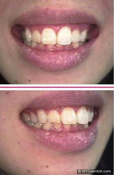Lip fungal infection is caused normally by candida yeast. Gallery Candida Lips Treatment