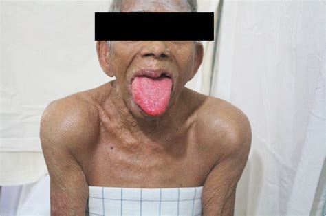 Shoulder Pad And Macroglossia Two Signs Of Al Amyloidosis