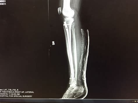Compound Fracture Of Tibia And Fibula Recovery
