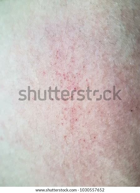 Breaking Out Rash Atopic Dermatitis Stock Photo 1030557652 Shutterstock