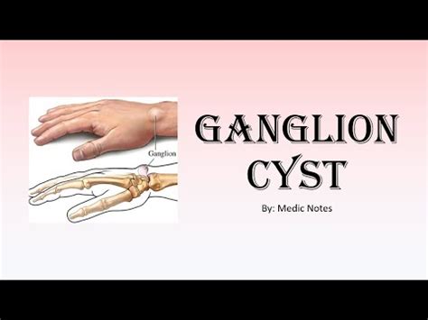 Ganglion Cyst Risk Factors Clinical Features Investigations