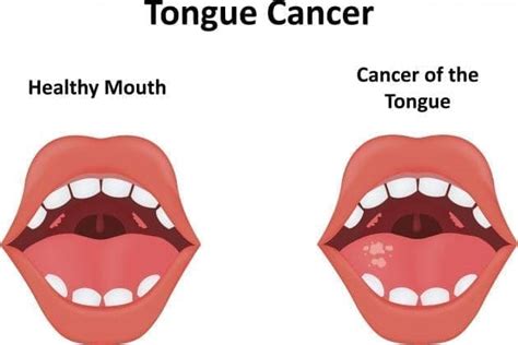 What Do Bumps On Back Of Tongue Mean 10 Likely Reasons Icy Health