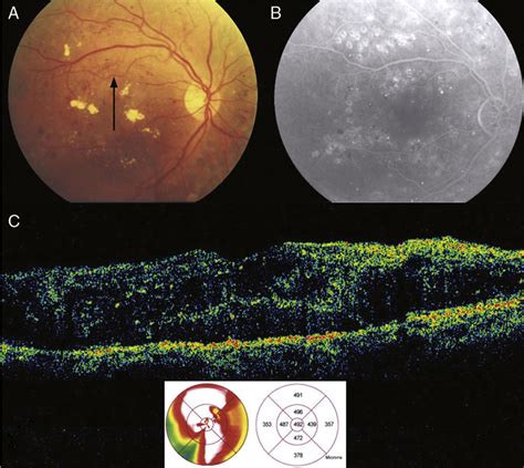 Patient 12 With Diabetic Retinopathy And Cystic Diabetic Macular