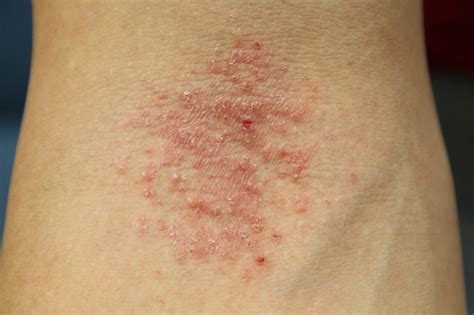 Dermatitis Rash On Arms