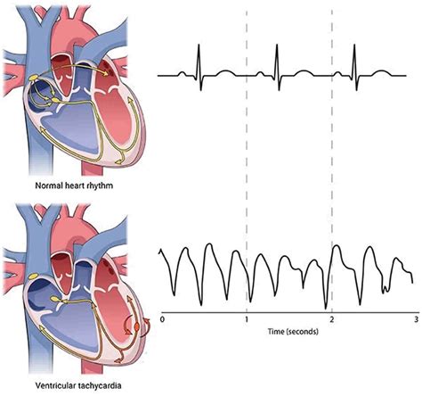 Ventricular Tachycardia Causes Symptoms Diagnosis Prognosis And Treatment