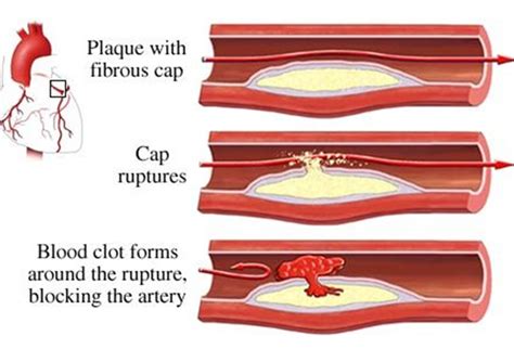 Arterial Thrombus Formation Modeled By Biophysicists Cardiology
